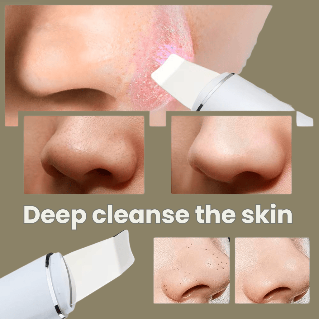 Before and after results from ultrasonic skin scrubber: clearer, lifted complexion